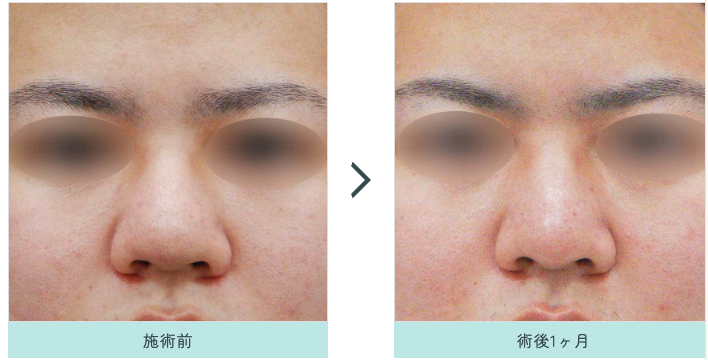 水の森美容クリニック　大阪院の鼻整形の症例写真(鼻尖縮小＋耳介軟骨移植)
