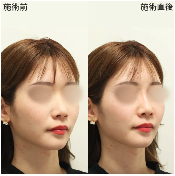 TAクリニック 大阪院の鼻整形の症例写真