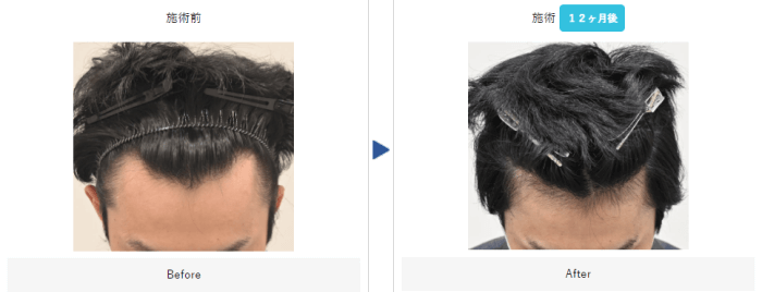 湘南AGAクリニックの自毛植毛の症例写真