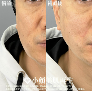 TCB東京中央美容外科の糸リフト症例写真