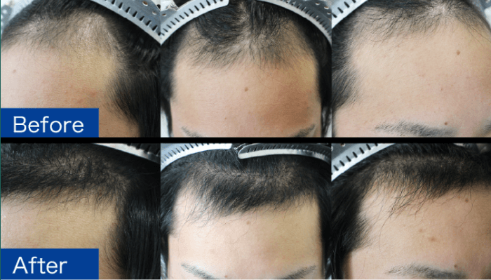 日本ウェルネス再生クリニックの自毛植毛の症例写真