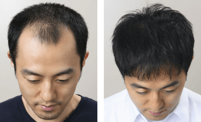 KM新宿クリニックの自毛植毛の症例写真