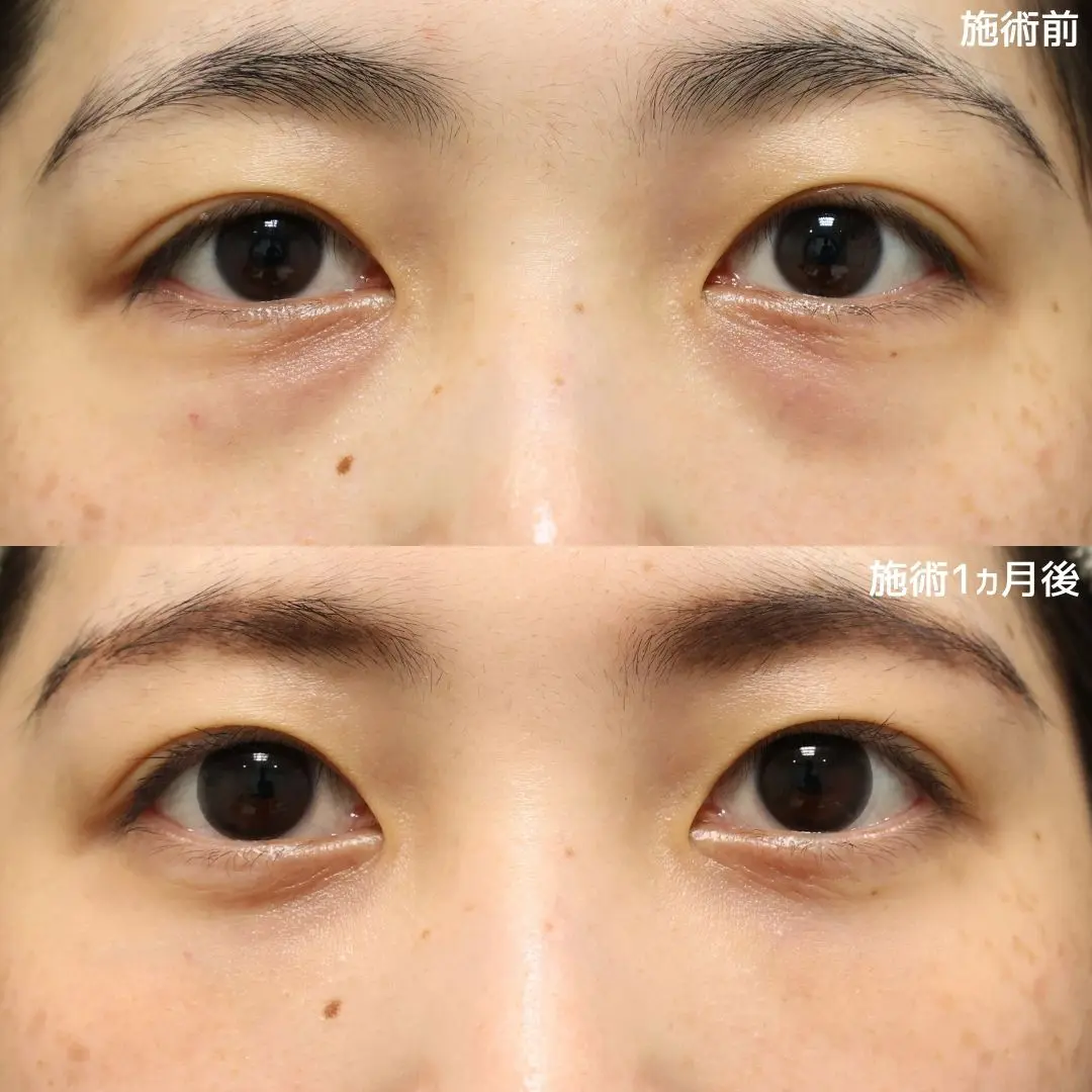 TAクリニックの下眼瞼脱脂術+脂肪注入の症例写真